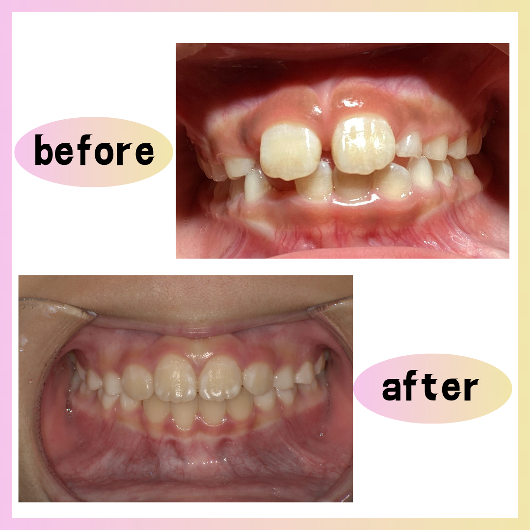 SAKU SMILE ORT矯正の症例のご紹介です(^_-)-☆